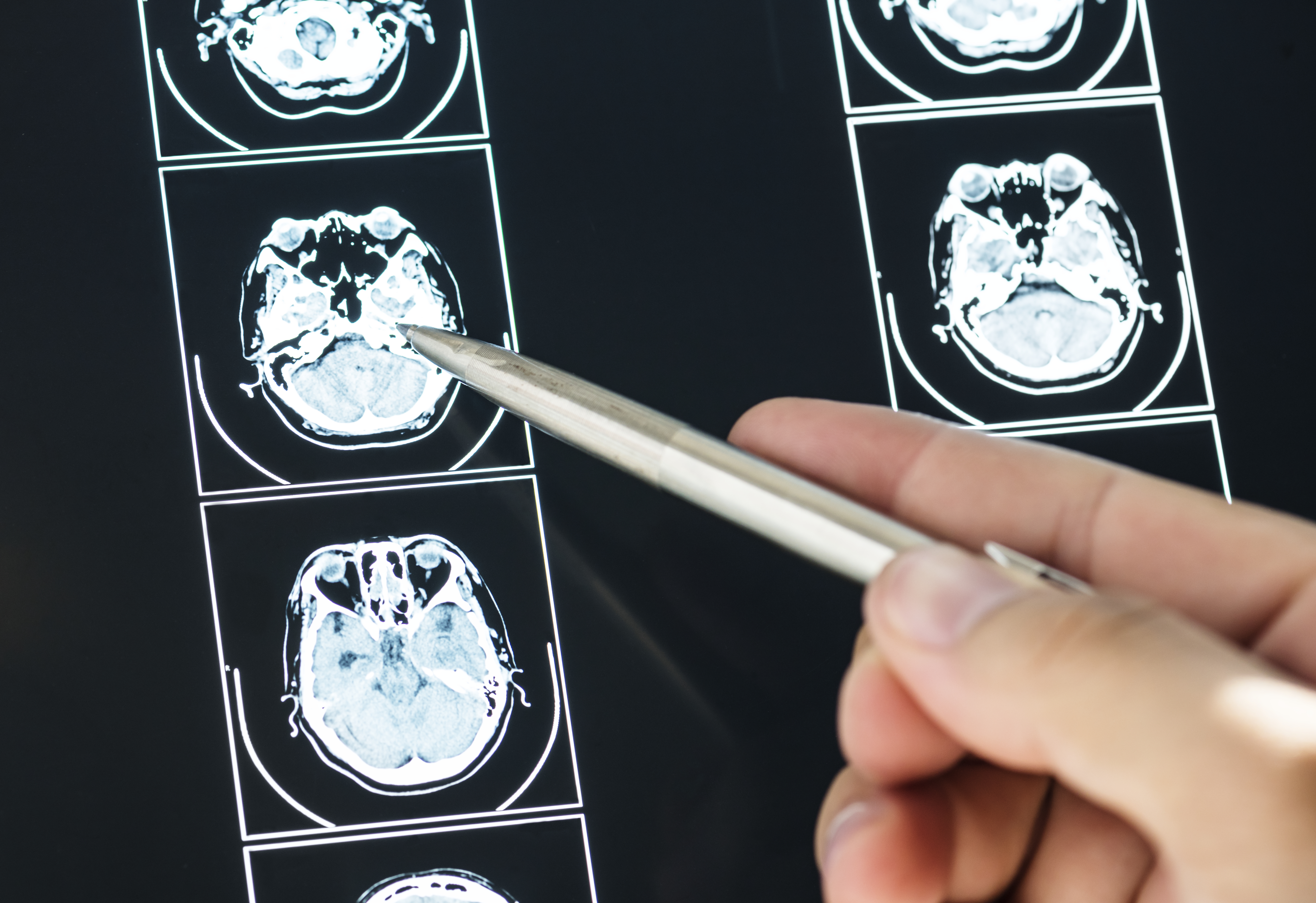 뇌경색 산재 과로 승인 가능성 검토를 위한 MRI 검사 이미지